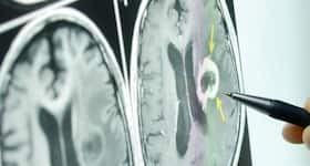 CT scan may increase brain tumor risk, says study CT scan may increase brain tumor risk, says study