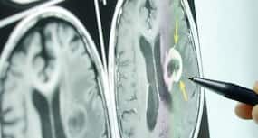CT scan may increase brain tumor risk, says study