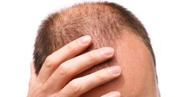 International Men S Health Week Types Of Hair Loss Identify