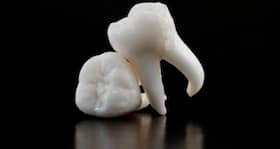 Tooth loss in elderly linked to malnutrition, finds study