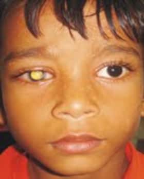 Awareness about eye cancer necessary in the country: Doctors