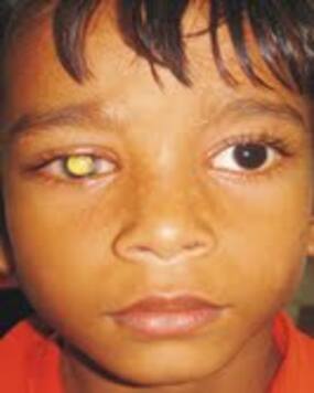 Awareness about eye cancer necessary in the country: Doctors