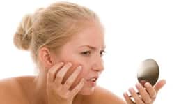 Do home remedies for acne really work?