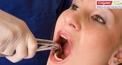 5 reasons why your tooth may need to be removed
