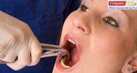 5 reasons why your tooth may need to be removed