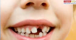 Dealing with tooth decay in children