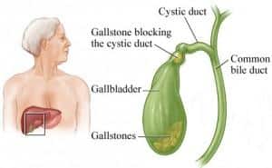Gallstones and gallbladder