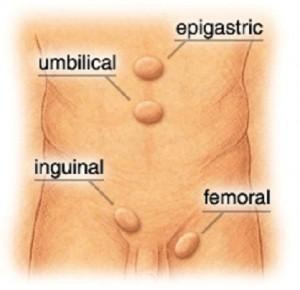 Types of hernias