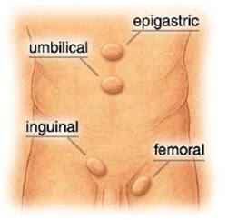 Smart tips to prevent an inguinal hernia
