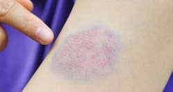 8 reasons for unexplained bruises on your body