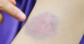 8 reasons for unexplained bruises on your body