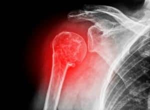 Fractures