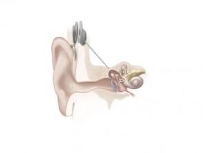 cochlear implant