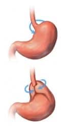 Fundoplication