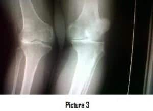Arthritic joint