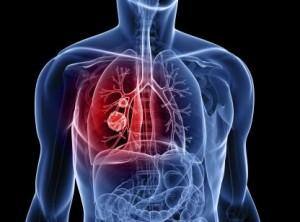 Lung cancer