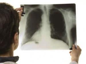 Tuberculosis