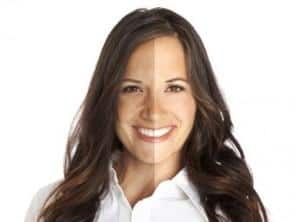 dermal fillers