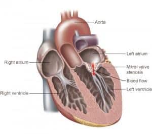 Mitral valve
