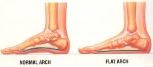 What are flat feet? | TheHealthSite.com