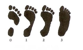 All you need to know about Flat Foot amongst children All you need to know about Flat Foot amongst children