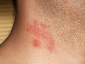 Herpes or shingles: An expert talks about prevention and treatment