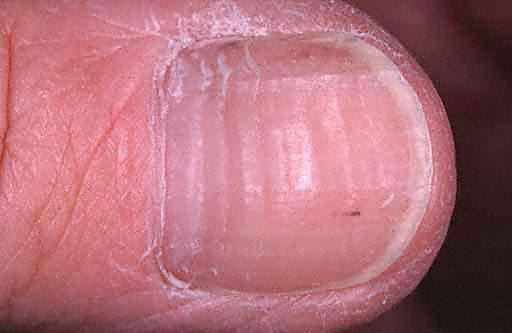 Top 10 Reasons For Brittle And Deformed Nails Read Health Related 9