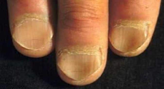 Top 10 reasons for brittle and deformed nails 