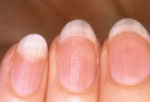 misshapen nails misshapen nails
