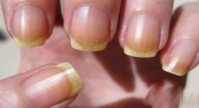 Top 10 reasons for brittle and deformed nails 