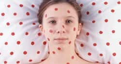 Measles: Try these simple home remedies to tackle it