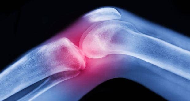 arthritis