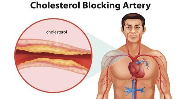 Atherosclerosis leading to coronary heart disease