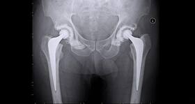Decreased opioid use beneficial for joint replacement surgery
