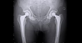 Decreased opioid use beneficial for joint replacement surgery
