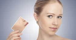Home remedies to get rid of acne scars from face