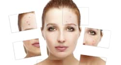 Did you know that vitamins could give you acne?