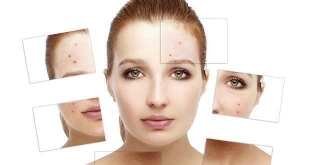 Tips to get rid of pimples