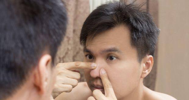 Acne scars