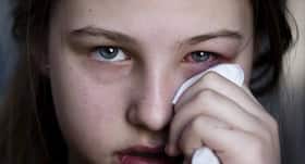 10 striking symptoms of viral conjunctivitis or pinkeye 10 striking symptoms of viral conjunctivitis or pinkeye