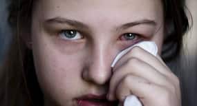 10 striking symptoms of viral conjunctivitis or pinkeye