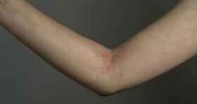 4 blood tests to detect allergies you should be aware of