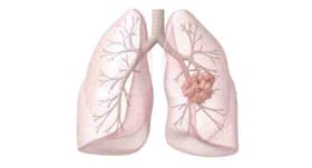 Signs and symptoms of lung cancer