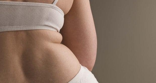 obesity-woman