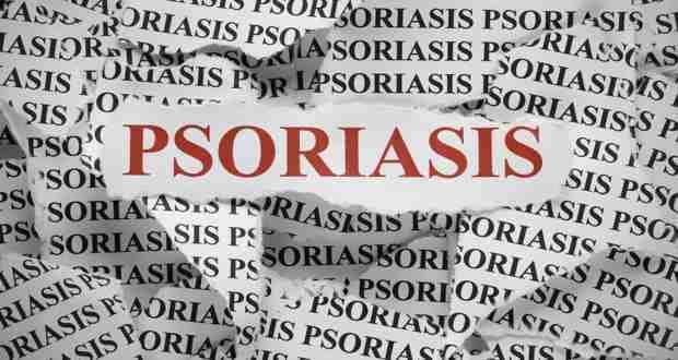 Natural remedies for psoriasis