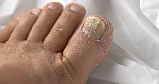Top 5 home remedies for toenail fungus 