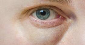 Himachal orders probe after patients lose eyesight in cataract surgeries