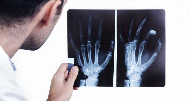 A blood test can check for fractures 