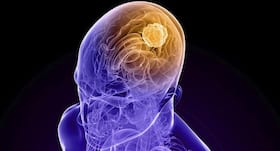 Brain cancer can be treated with a combination of radiotherapy and drugs: Study