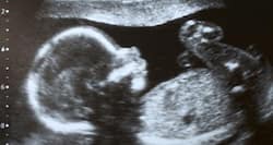 What is fetal distress?